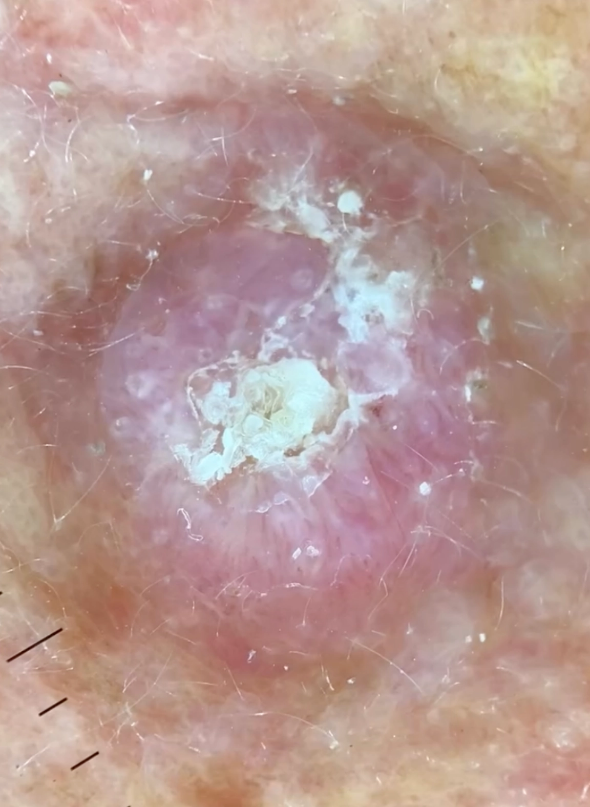 Dermatoscopía - Ismael