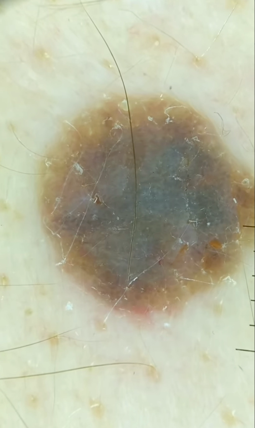 Dermatoscopía - María Eliana