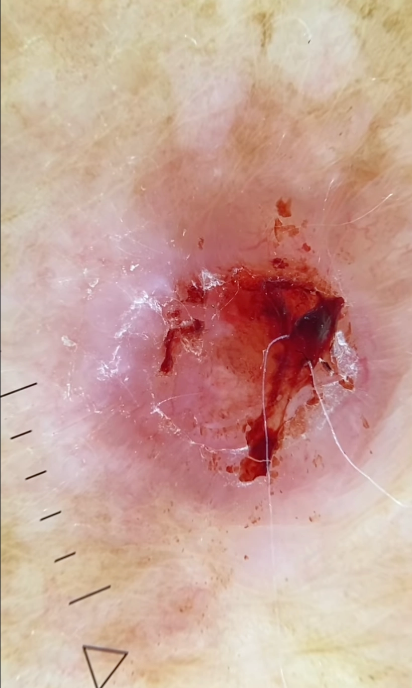 Dermatoscopía - Eugenia